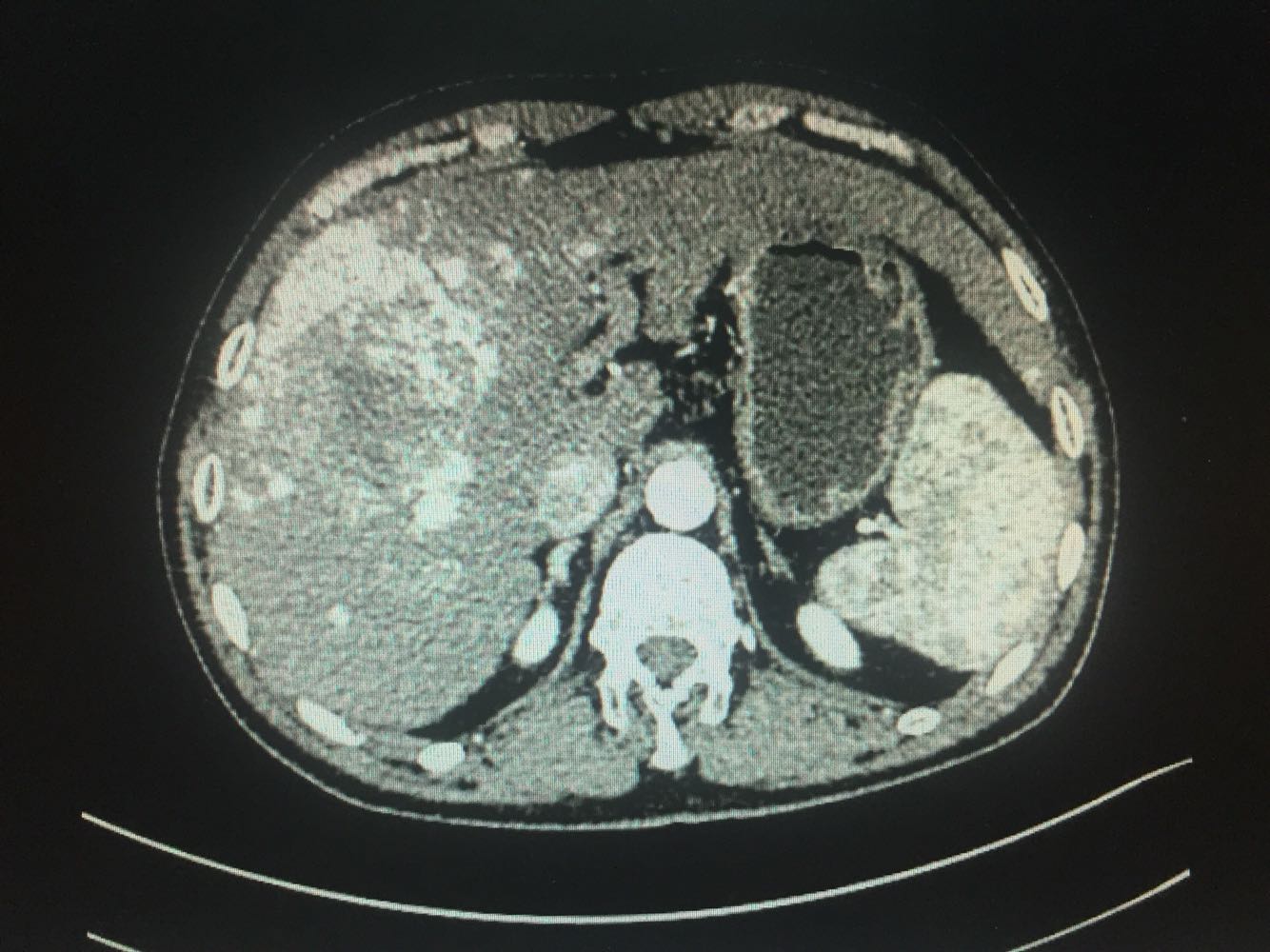 乙肝肝硬化原发性肝癌
