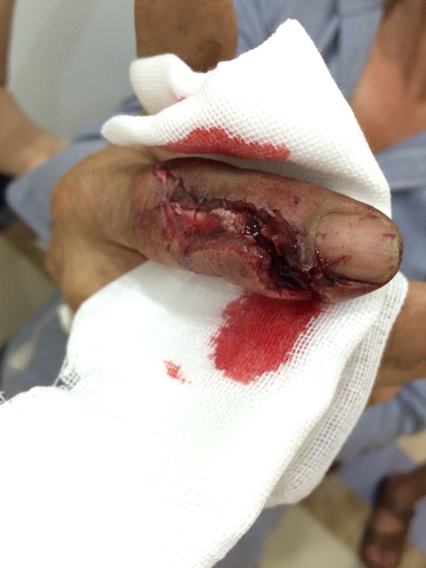 电锯割伤手指致手指开放性骨折