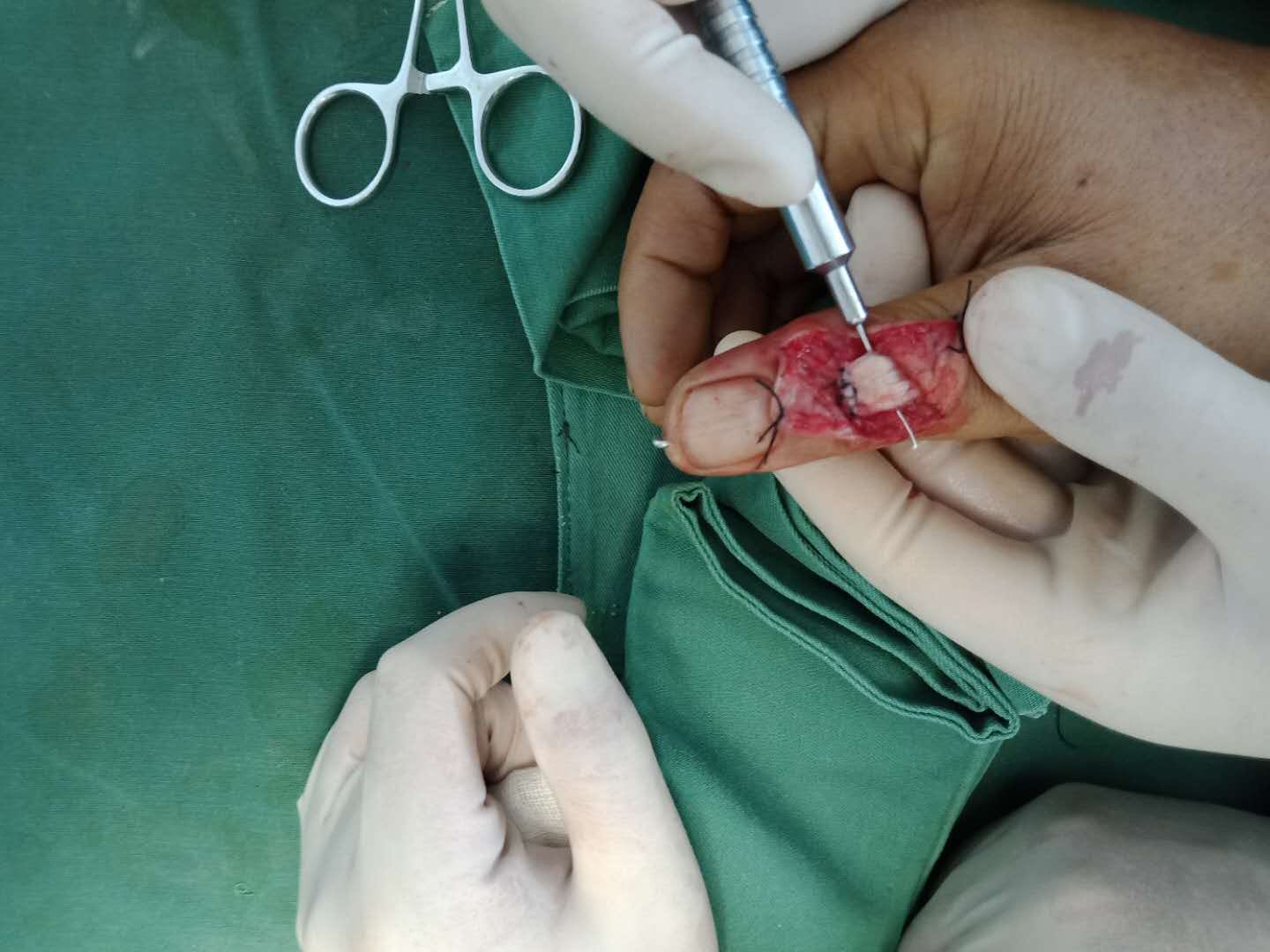 拇指锤状指掌骨骨折切复内固定